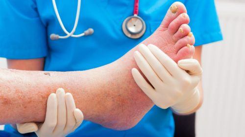 Diabetic foot syndrome - description, treatment